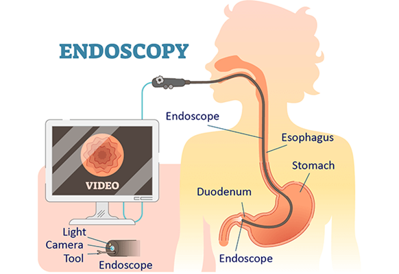 Upper GI Endoscopy